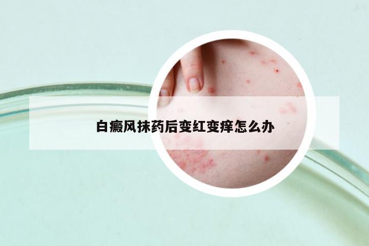 白癜風(fēng)抹藥后變紅變癢怎么辦