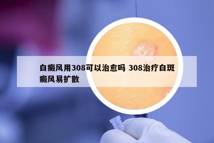 白癜風用308可以治愈嗎 308治療白斑癜風易擴散