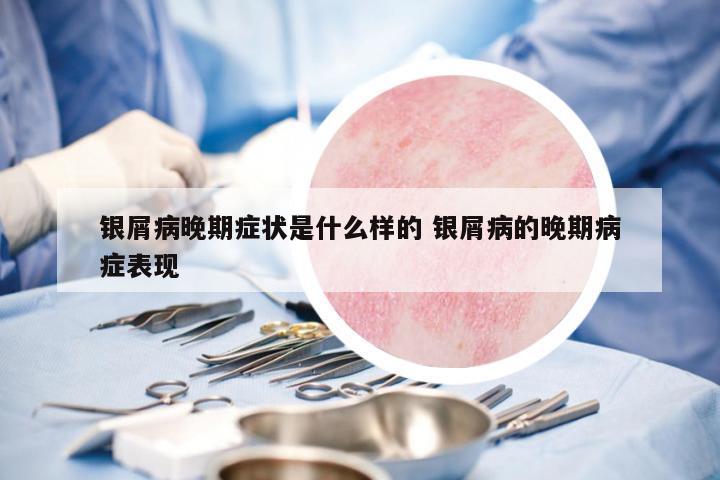 銀屑病晚期癥狀是什么樣的 銀屑病的晚期病癥表現(xiàn)