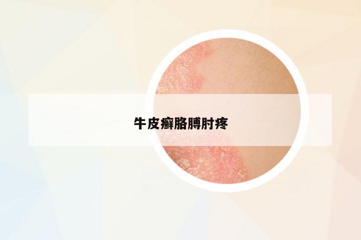 牛皮癬胳膊肘疼