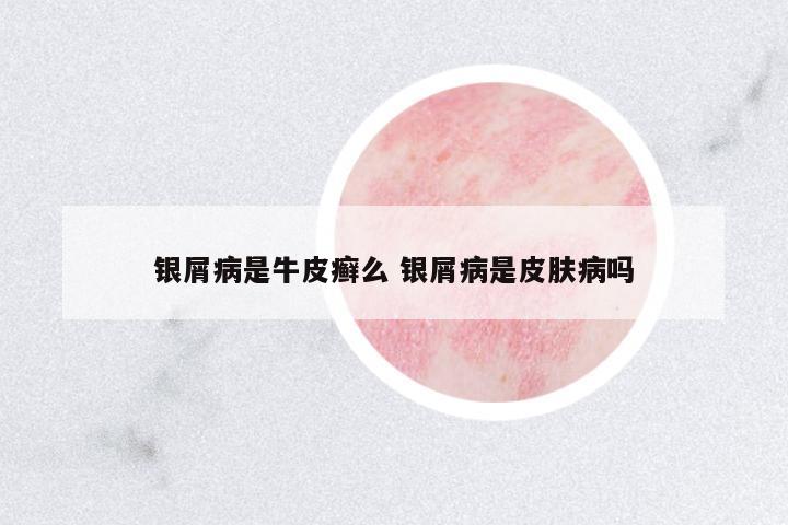 銀屑病是牛皮癬么 銀屑病是皮膚病嗎