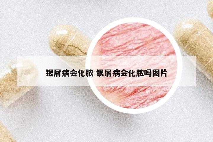 銀屑病會化膿 銀屑病會化膿嗎圖片