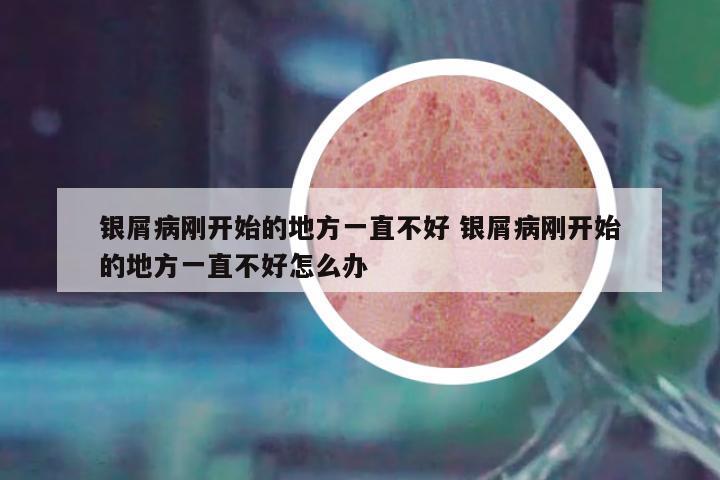 銀屑病剛開始的地方一直不好 銀屑病剛開始的地方一直不好怎么辦