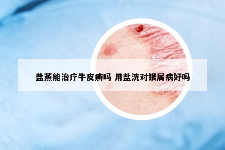 鹽蒸能治療牛皮癬嗎 用鹽洗對銀屑病好嗎