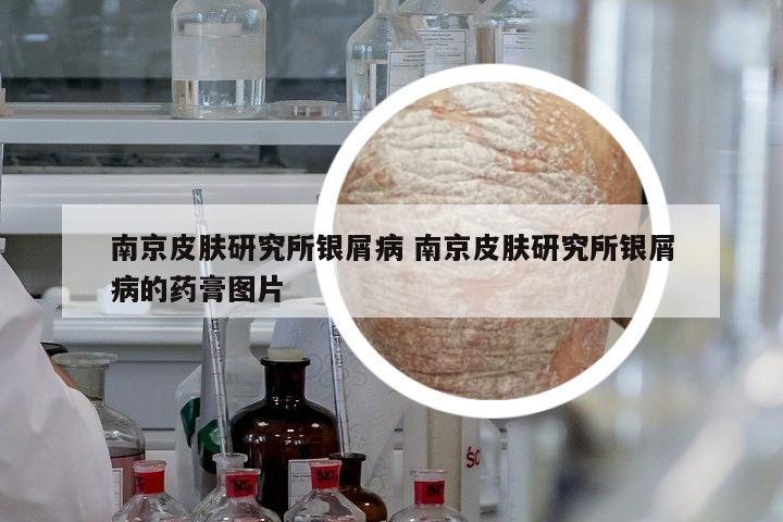 南京皮膚研究所銀屑病 南京皮膚研究所銀屑病的藥膏圖片