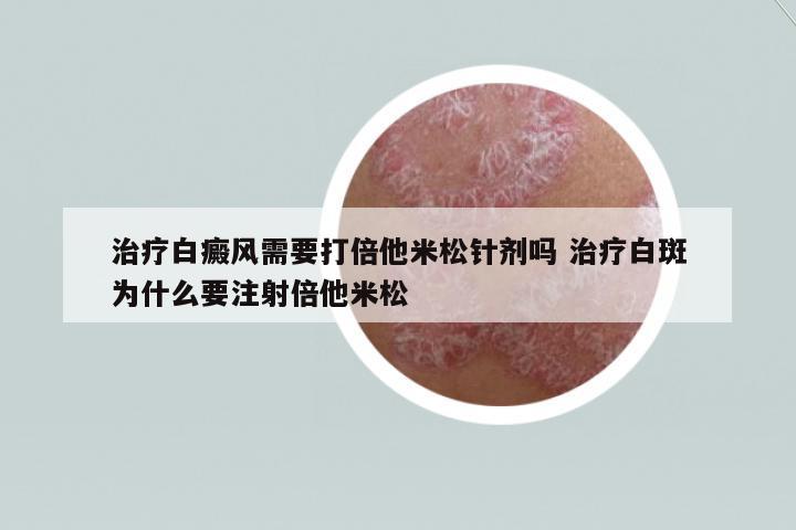 治療白癜風(fēng)需要打倍他米松針劑嗎 治療白斑為什么要注射倍他米松