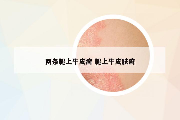 兩條腿上牛皮癬 腿上牛皮膚癬