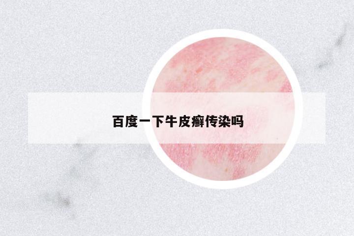 百度一下牛皮癬傳染嗎