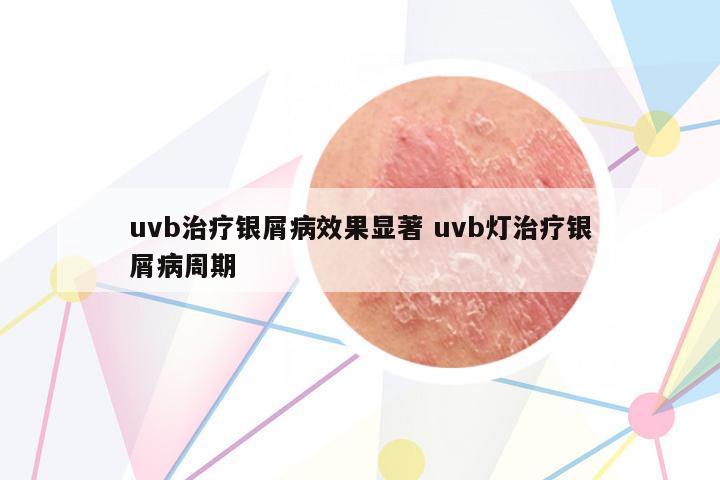 uvb治療銀屑病效果顯著 uvb燈治療銀屑病周期