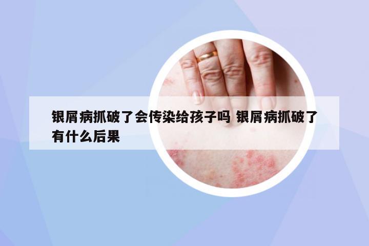 銀屑病抓破了會(huì)傳染給孩子嗎 銀屑病抓破了有什么后果