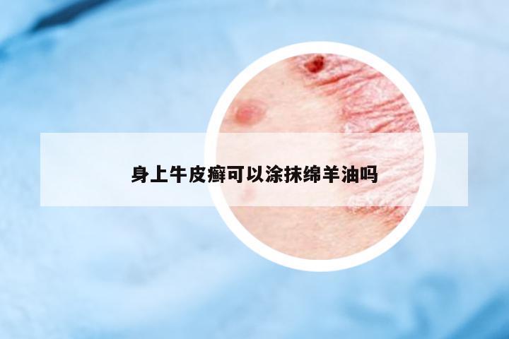 身上牛皮癬可以涂抹綿羊油嗎