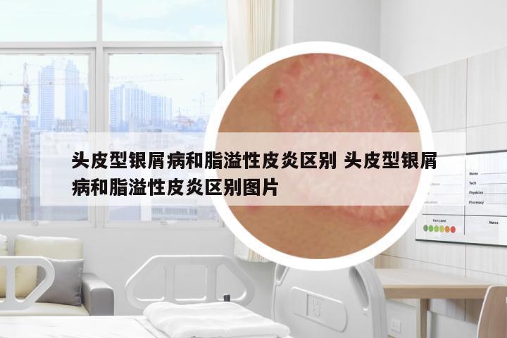 頭皮型銀屑病和脂溢性皮炎區(qū)別 頭皮型銀屑病和脂溢性皮炎區(qū)別圖片