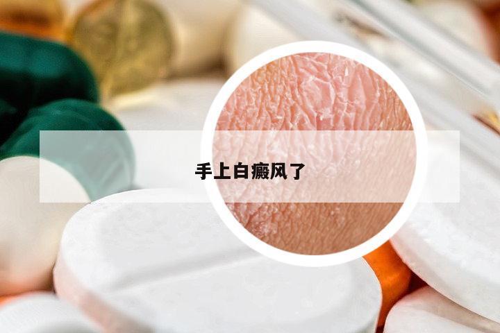 手上白癜風(fēng)了