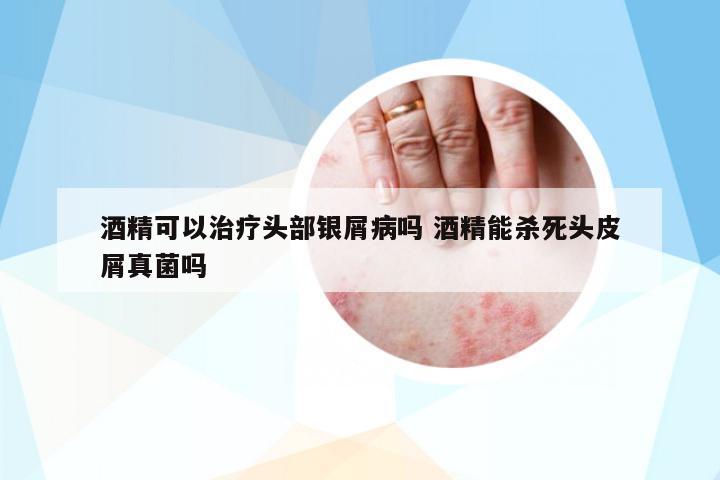 酒精可以治療頭部銀屑病嗎 酒精能殺死頭皮屑真菌嗎