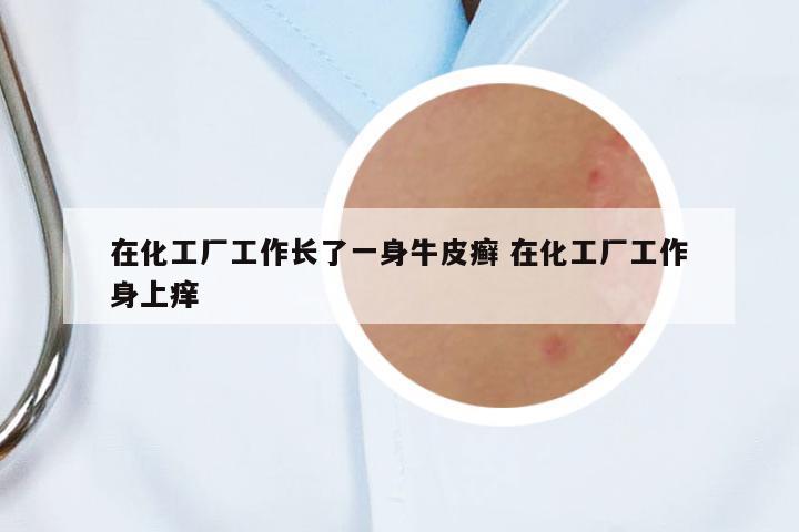 在化工廠工作長(zhǎng)了一身牛皮癬 在化工廠工作身上癢