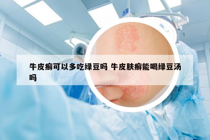 牛皮癬可以多吃綠豆嗎 牛皮膚癬能喝綠豆湯嗎