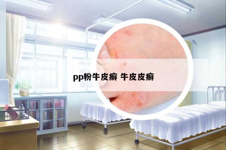 pp粉牛皮癬 牛皮皮癬