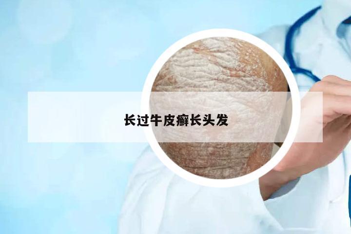 長(zhǎng)過牛皮癬長(zhǎng)頭發(fā)