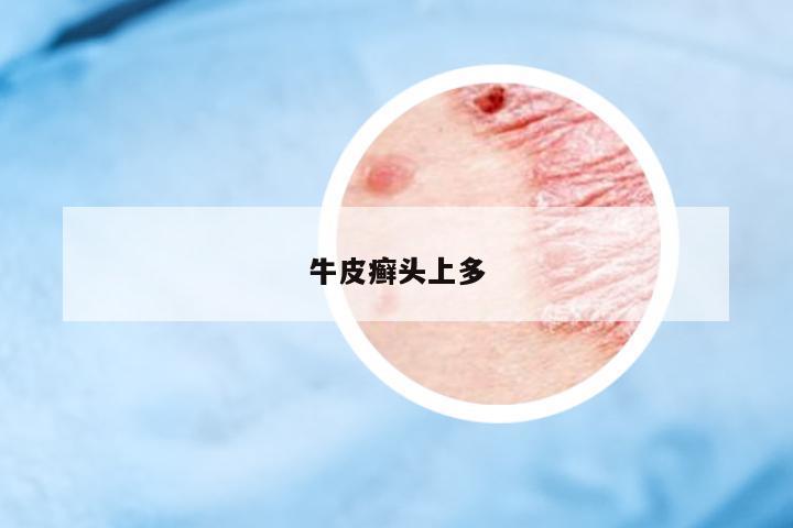 牛皮癬頭上多