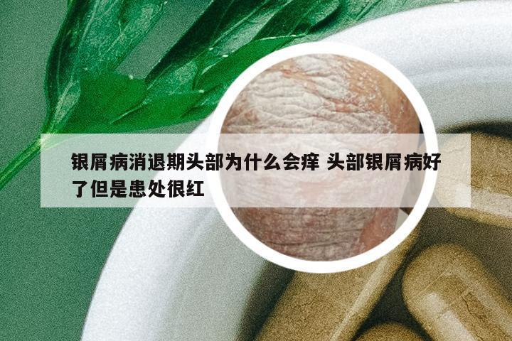 銀屑病消退期頭部為什么會(huì)癢 頭部銀屑病好了但是患處很紅