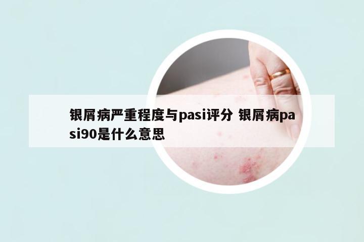 銀屑病嚴(yán)重程度與pasi評(píng)分 銀屑病pasi90是什么意思