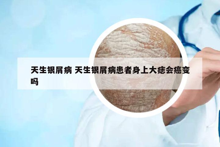 天生銀屑病 天生銀屑病患者身上大痣會癌變嗎
