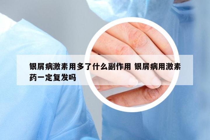 銀屑病激素用多了什么副作用 銀屑病用激素藥一定復(fù)發(fā)嗎