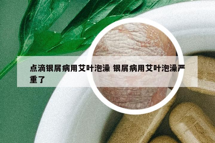 點滴銀屑病用艾葉泡澡 銀屑病用艾葉泡澡嚴(yán)重了