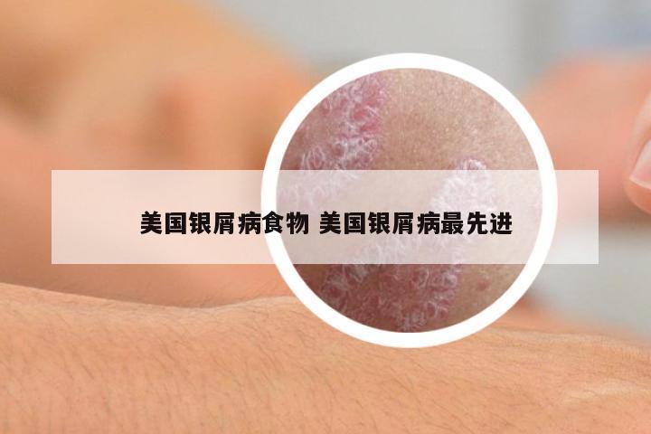 美國銀屑病食物 美國銀屑病最先進(jìn)