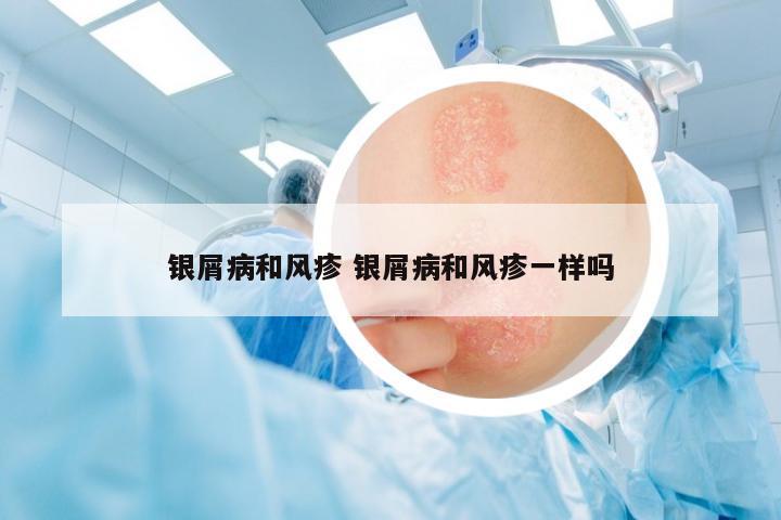 銀屑病和風(fēng)疹 銀屑病和風(fēng)疹一樣嗎