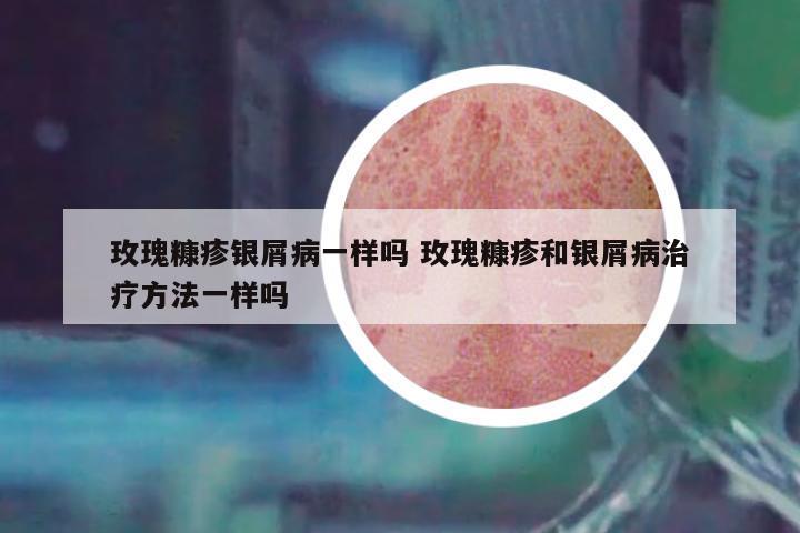 玫瑰糠疹銀屑病一樣嗎 玫瑰糠疹和銀屑病治療方法一樣嗎