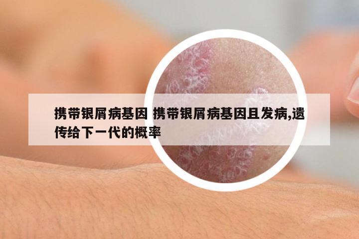 攜帶銀屑病基因 攜帶銀屑病基因且發(fā)病,遺傳給下一代的概率