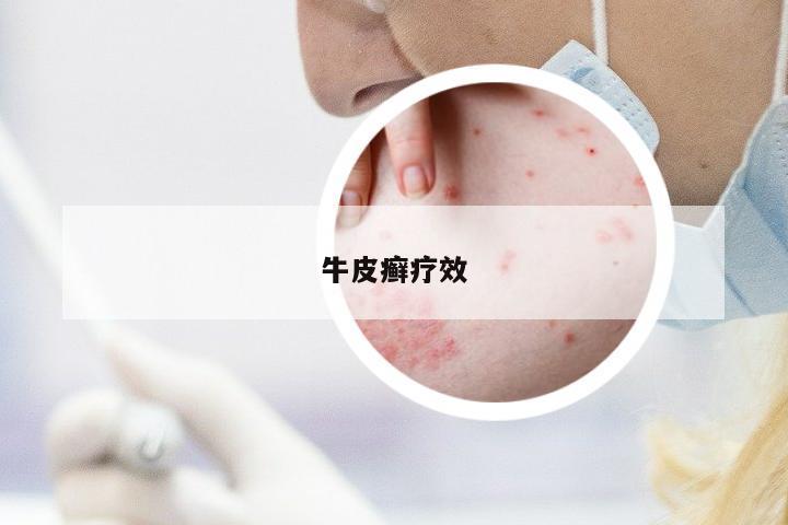 牛皮癬療效