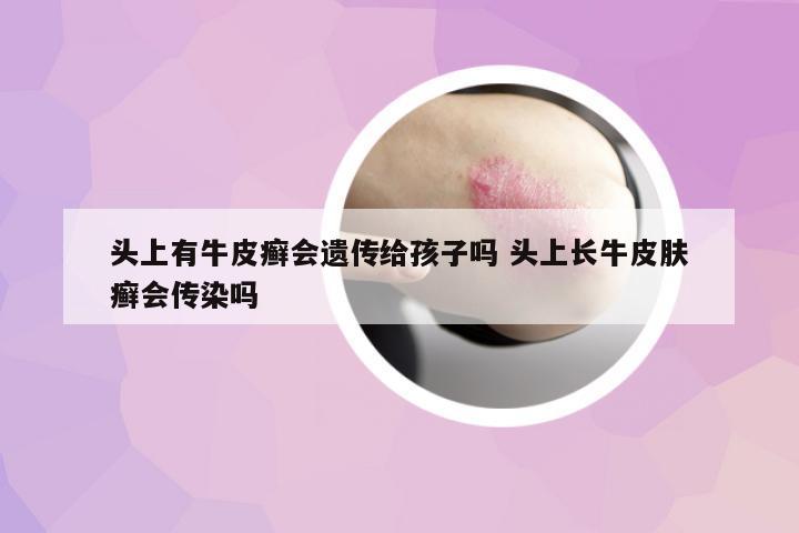 頭上有牛皮癬會遺傳給孩子嗎 頭上長牛皮膚癬會傳染嗎