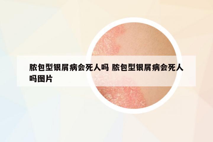 膿包型銀屑病會(huì)死人嗎 膿包型銀屑病會(huì)死人嗎圖片