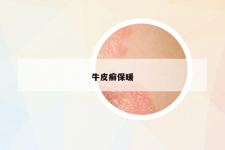 牛皮癬保暖