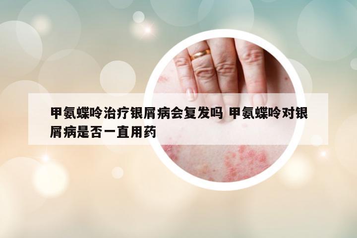 甲氨蝶呤治療銀屑病會(huì)復(fù)發(fā)嗎 甲氨蝶呤對(duì)銀屑病是否一直用藥