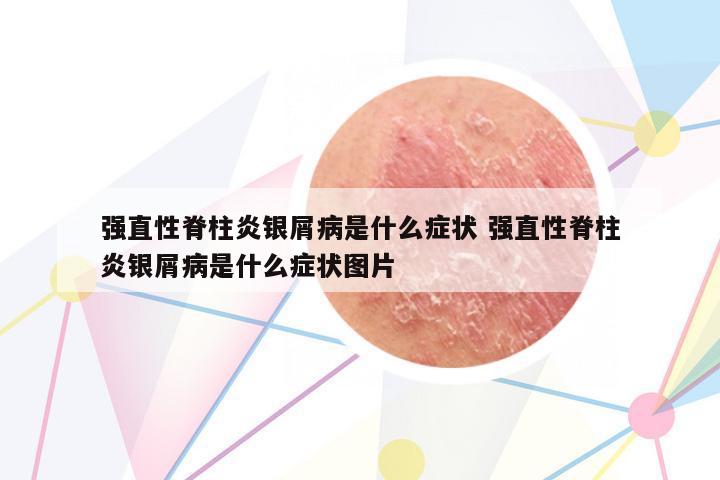 強(qiáng)直性脊柱炎銀屑病是什么癥狀 強(qiáng)直性脊柱炎銀屑病是什么癥狀圖片