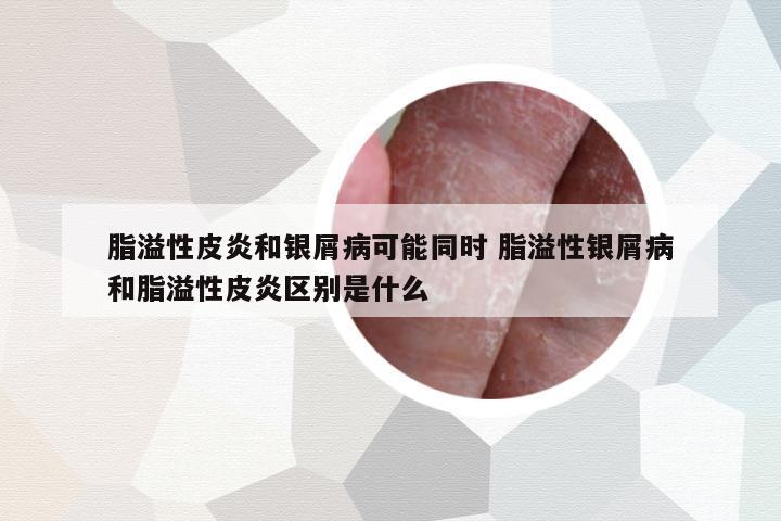 脂溢性皮炎和銀屑病可能同時 脂溢性銀屑病和脂溢性皮炎區(qū)別是什么