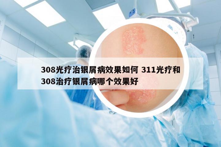 308光療治銀屑病效果如何 311光療和308治療銀屑病哪個(gè)效果好