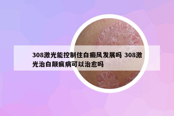 308激光能控制住白癜風(fēng)發(fā)展嗎 308激光治白顛瘋病可以治愈嗎