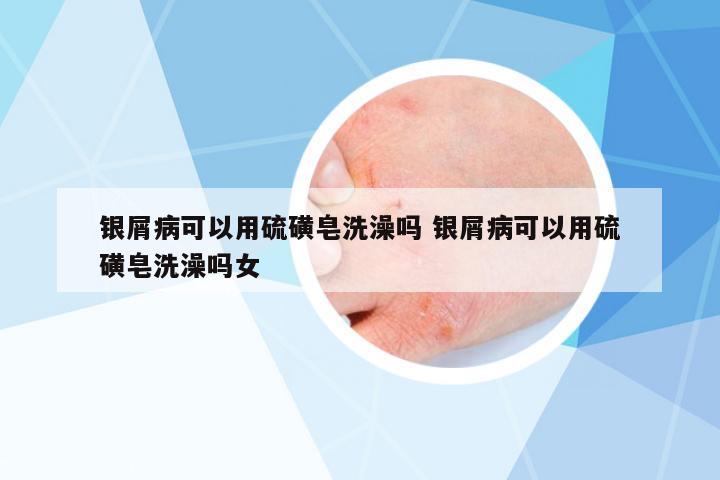銀屑病可以用硫磺皂洗澡嗎 銀屑病可以用硫磺皂洗澡嗎女