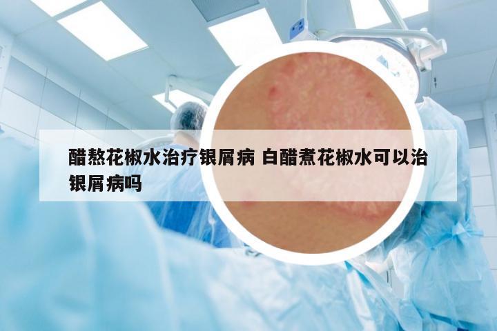 醋熬花椒水治療銀屑病 白醋煮花椒水可以治銀屑病嗎