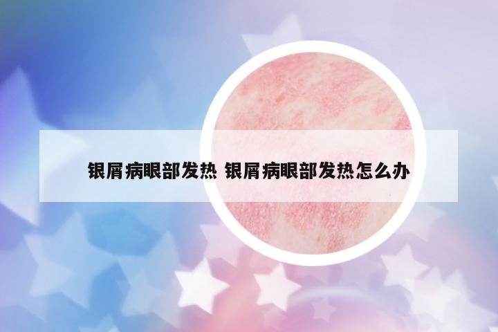 銀屑病眼部發(fā)熱 銀屑病眼部發(fā)熱怎么辦