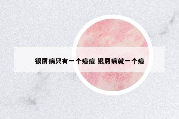 銀屑病只有一個痘痘 銀屑病就一個痘