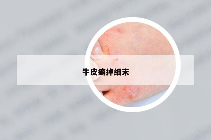 牛皮癬掉細(xì)末