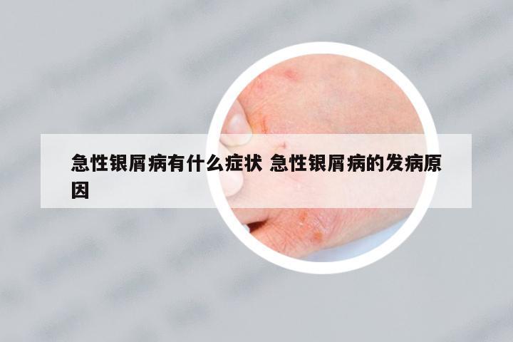 急性銀屑病有什么癥狀 急性銀屑病的發(fā)病原因