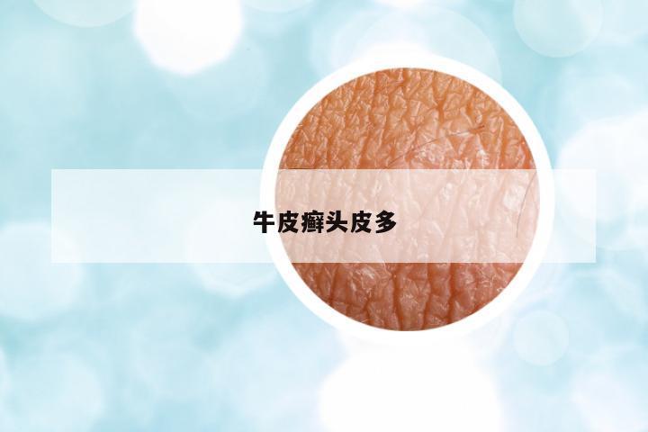 牛皮癬頭皮多