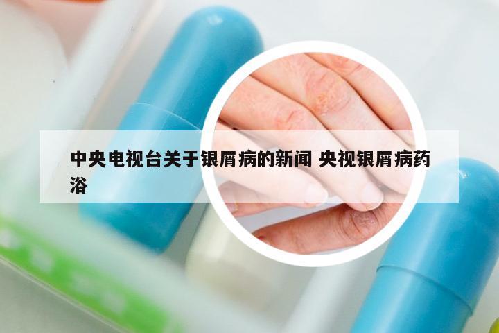 中央電視臺關(guān)于銀屑病的新聞 央視銀屑病藥浴