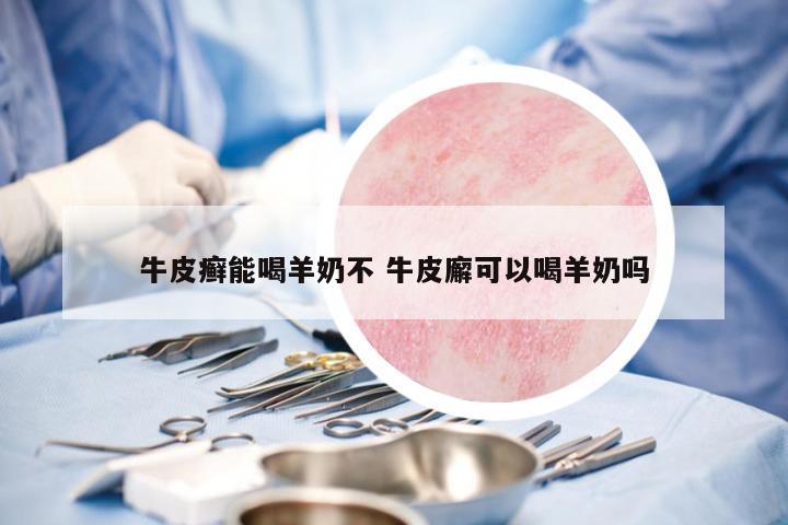 牛皮癬能喝羊奶不 牛皮廨可以喝羊奶嗎